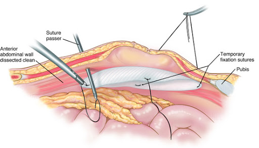 hernia-repair_dnepr_St.Antipa_Semashko_laparo.jpg