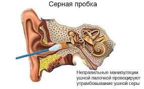 серная пробка, ЛОР-врач, промывание уха