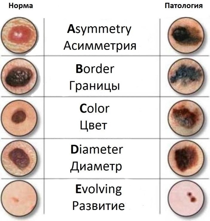 Рак кожи.jpg Рак кожи.jpg